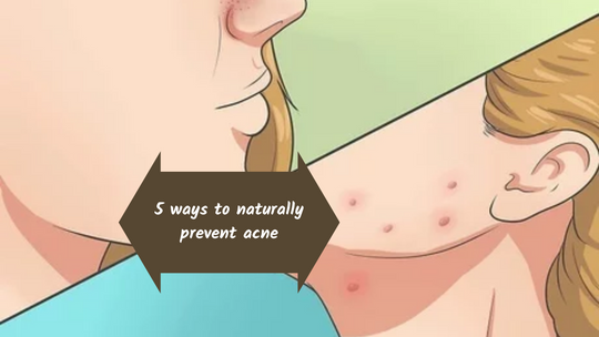 5 ways to naturally prevent acne