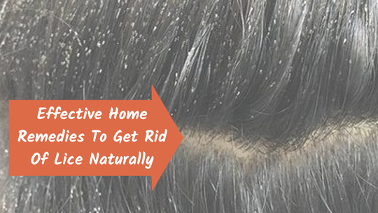 Effective Home Remedies To Get Rid Of Lice Naturally