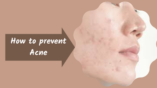 How to prevent acne